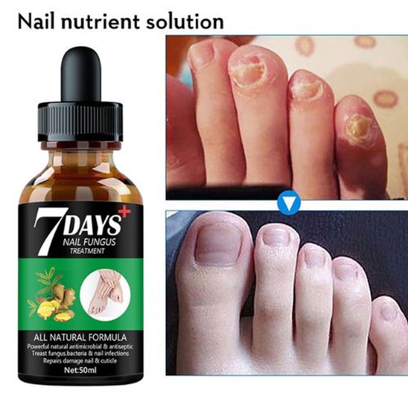 Foot Nail Fungus Treatment Serum YUH Enterprises